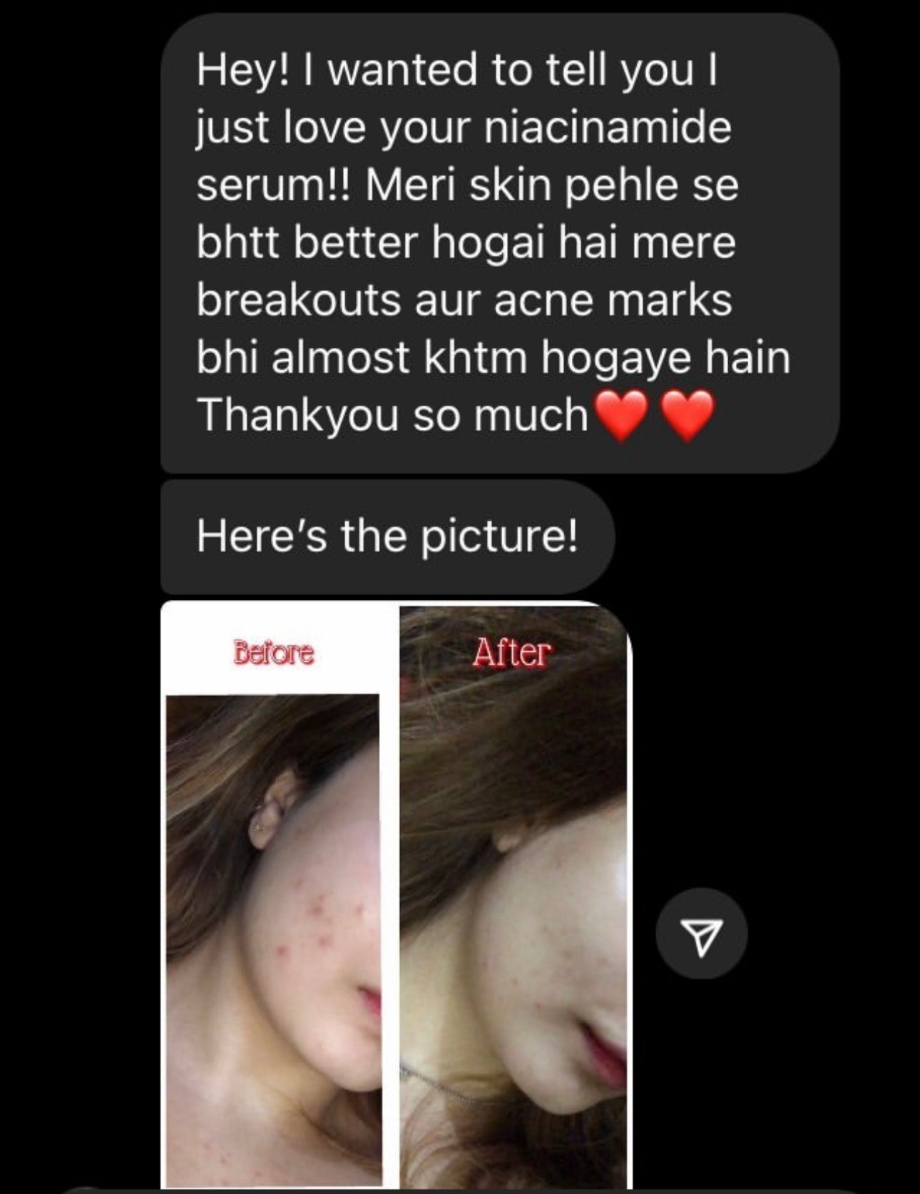 Summers Acne Bundle