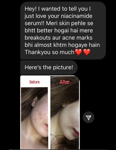 Summers Acne Bundle